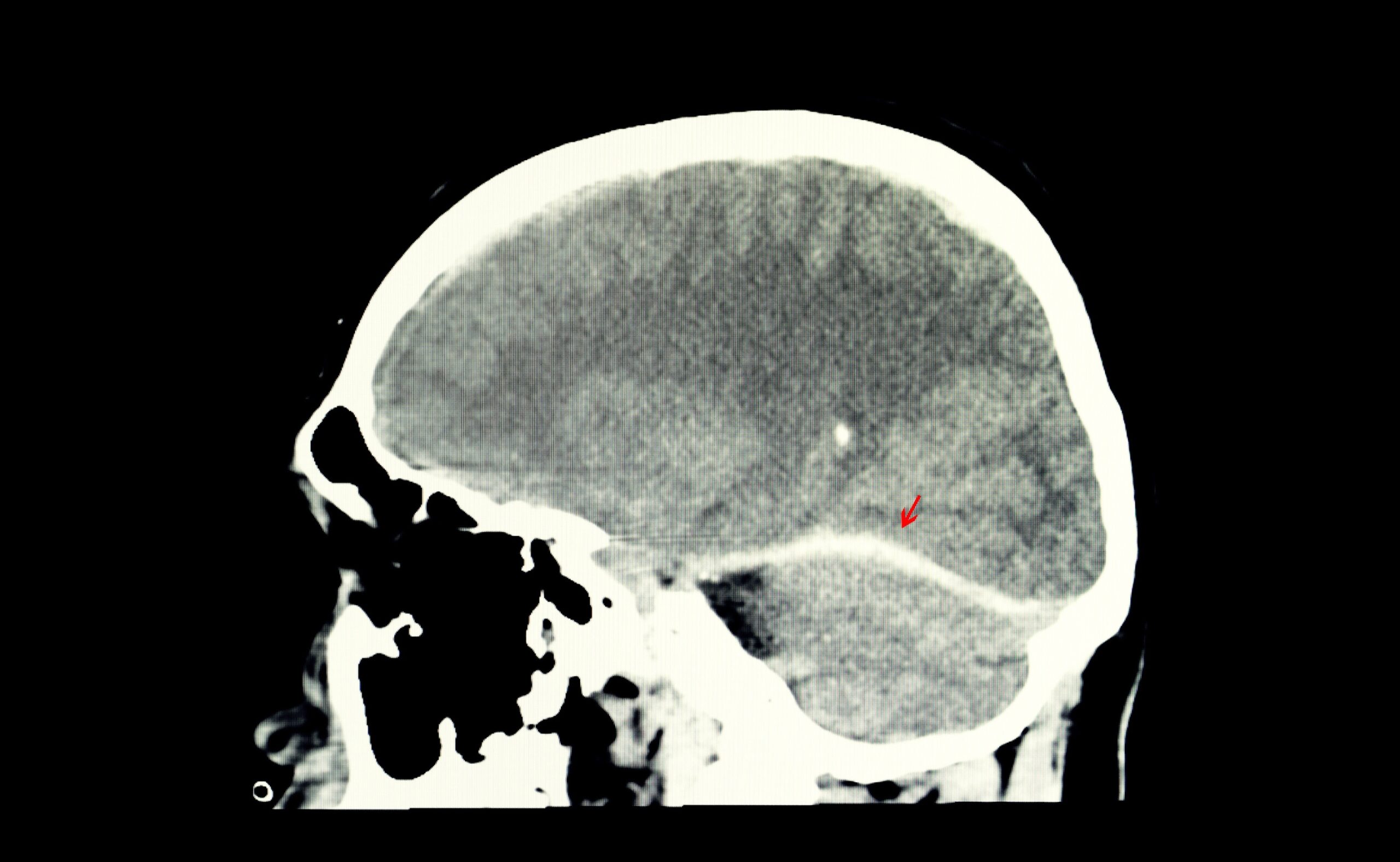xray of traumatic brain injury